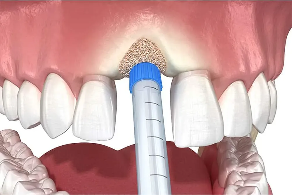 bonegrafting