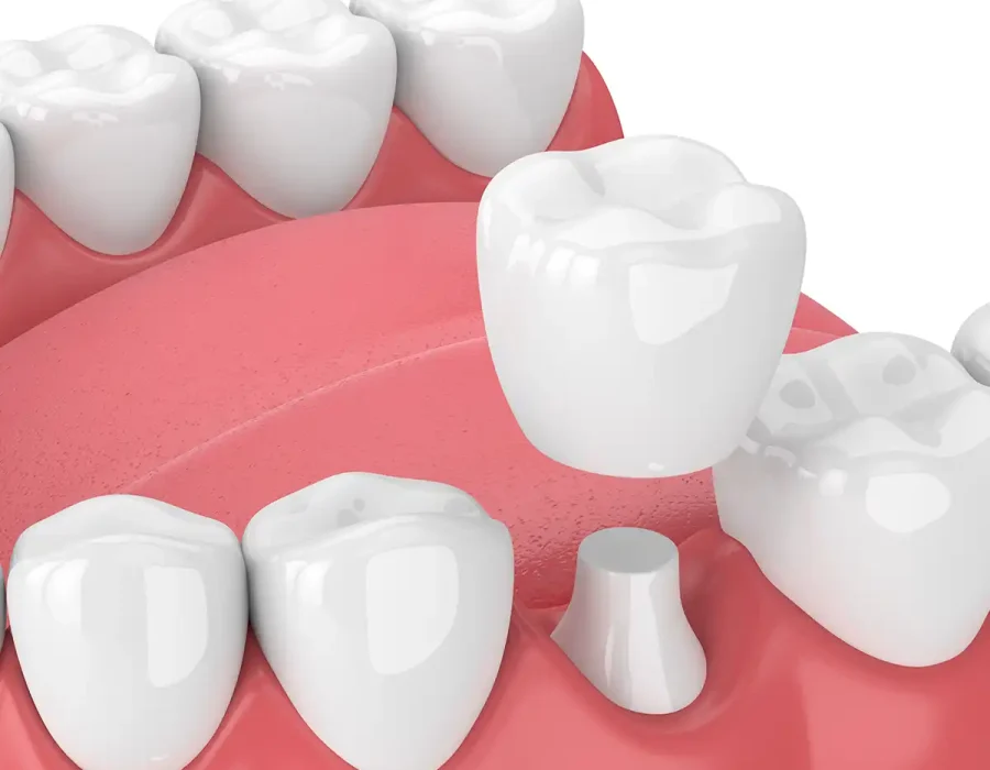 dental-crown